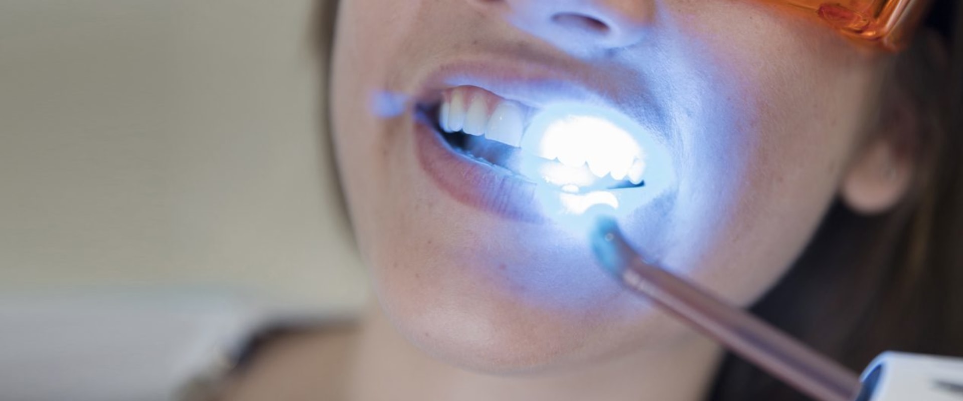 Brighten Your Smile: Tips For Safe Teeth Whitening In Austin For Those With Dental Allergies