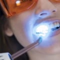 Brighten Your Smile: Tips For Safe Teeth Whitening In Austin For Those With Dental Allergies